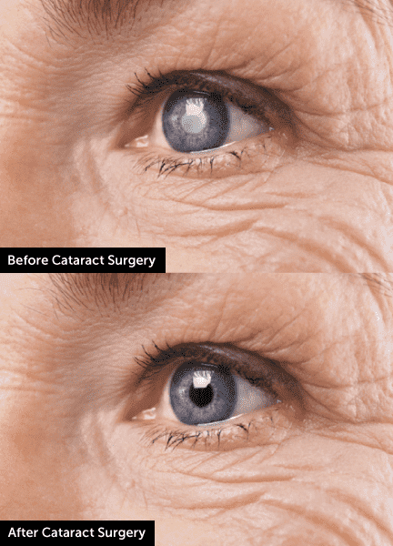 Cataract Eye Surgery In Iowa Wolfe Eye Clinic 